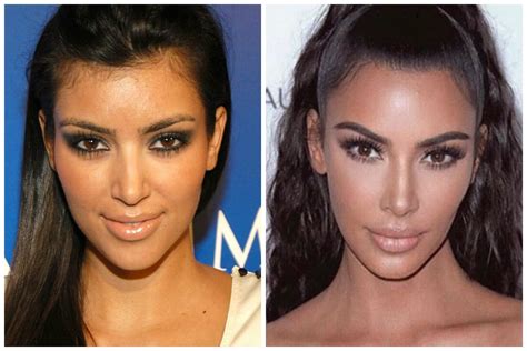 kim kardashian surgery.